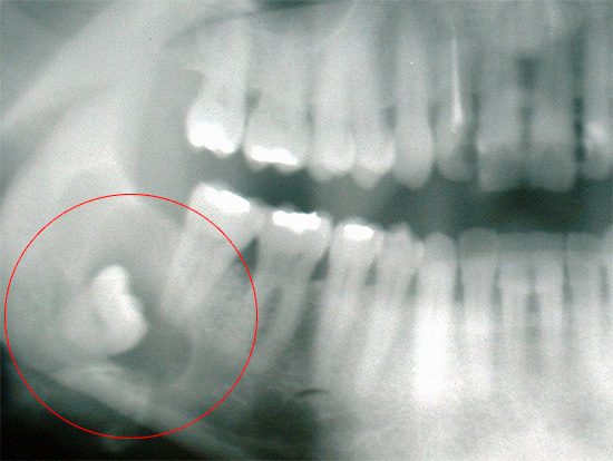 Do not rely on the fact that the wisdom tooth erupts and the pain disappears, it is better to immediately see a dentist.