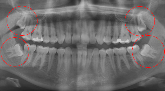 Četri gudrības zobi ir skaidri redzami panorāmas attēlā.