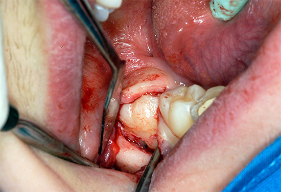 Aby pomóc wybuchom zęba mądrości, wcześniej często stosowano metodę wycinania kaptura dziąsłowego.