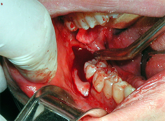Excisie van de tandvleeskap helpt niet altijd om het probleem van ettering in het tandvlees op te lossen ...