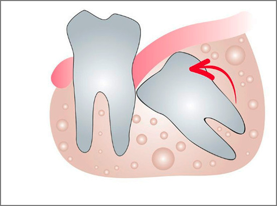 La croissance des dents de sagesse peut entraîner une malocclusion grave