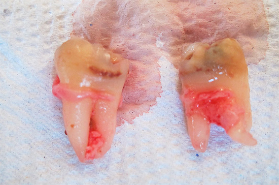 Gigi gigi dibuang