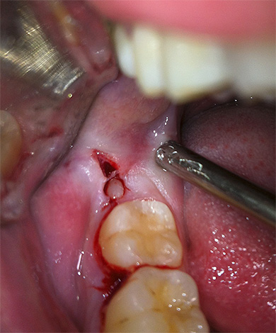La couronne de la dent de sagesse est visible dans l'incision de la gencive