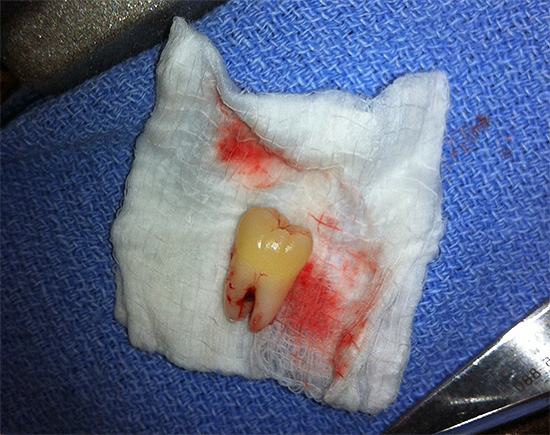 Jos poistat hartsia ärsyttävän hampan ajoissa leikkauksella, se välttää monia ongelmia tulevaisuudessa.