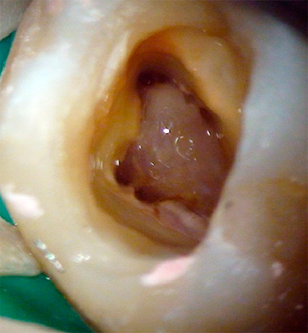 Complete removal of inflamed pulp from the root canals allows you to save the tooth from the source of infection.