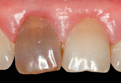 Taip atrodo dantis praėjus tam tikram laikui po pulpito gydymo, naudojant rezorcinolio-formalino pastą.