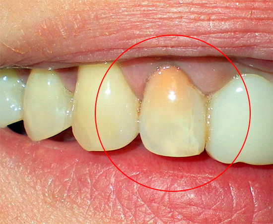 Ett annat exempel på en tand behandlad med resorcinol-formalinmetoden för mumifiering av massan.