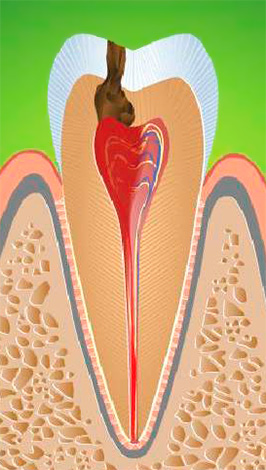 Dans la pulpite fibreuse chronique, un remplacement progressif des fibres nerveuses par du tissu conjonctif se produit, ce qui entraîne une diminution de la sensibilité de la pulpe à divers stimuli.