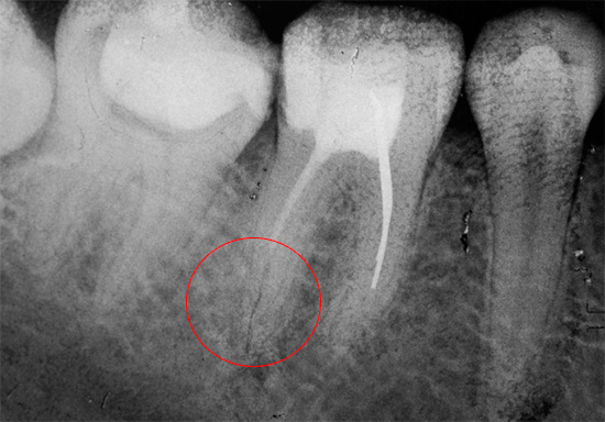 Not fully sealed tooth canal