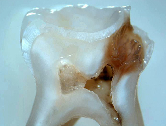A section of a tooth with a deep carious cavity, having a through communication with the pulp chamber.