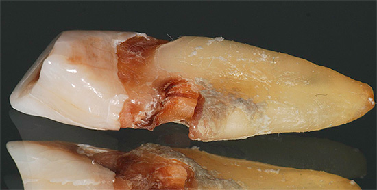 De foto toont een diepe carieuze holte aan de wortel van de tand.