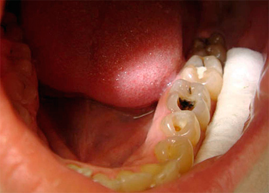 Une méthode de diagnostic importante est la thermométrie, au cours de laquelle la sensibilité de la dent à l'action d'un irritant de la température est évaluée.