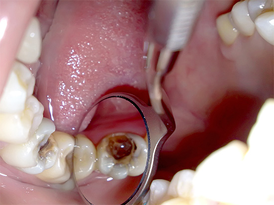 Conocemos las características de la pulpitis gangrenosa crónica: ¿cuál es el peligro de la necrosis pulpar dentro de los conductos radiculares del diente?