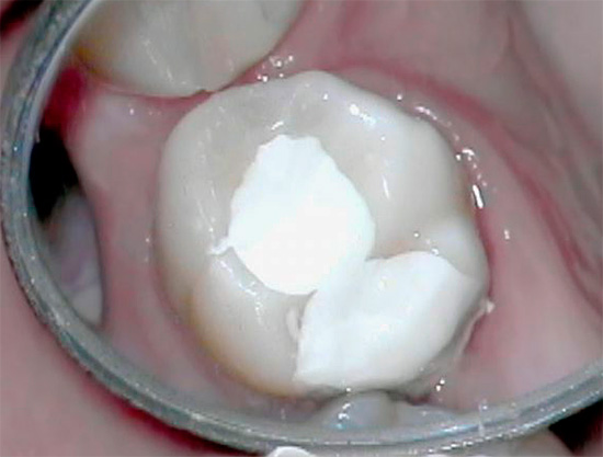 The placement of devitalizing paste on the tooth and the subsequent hermetic closure of the cavity with a temporary filling in case of chronic gangrenous pulpitis are not always justified.