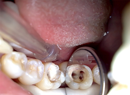 Na fotografii je jasne viditeľná ústa koreňových kanálikov zuba