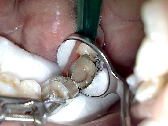 Sedan börjar restaureringen av vävnaderna som tappas av tanden.