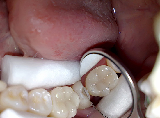 Och så ser en tand ut i slutet av behandling med pulpit - det kan inte skiljas från en levande.