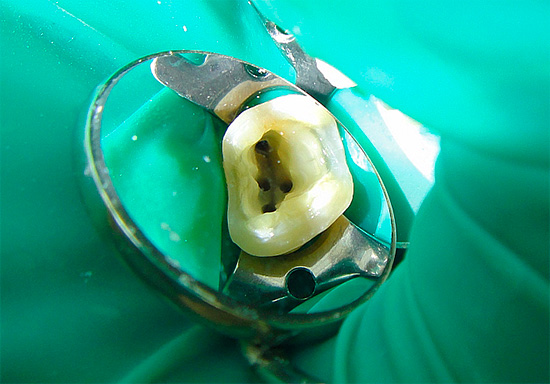Plus il y a de canaux radiculaires dans une dent, plus le traitement de la pulpite coûte cher.
