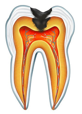 Wenn die Bakterien während einer tiefen Karies in die Pulpakammer des Zahns gelangen, entzündet sich das neurovaskuläre Bündel unweigerlich mit einem möglichen nachfolgenden eitrigen Zerfall.