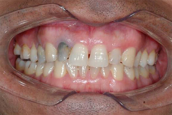 Šedý odtieň zuba zobrazený na fotografii môže naznačovať chronickú gangrenóznu pulpitídu.