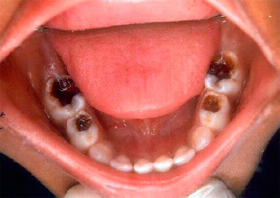 Parfois, la pulpite gangreneuse chronique affecte plusieurs dents à la fois, ce qui est particulièrement typique pour les enfants.