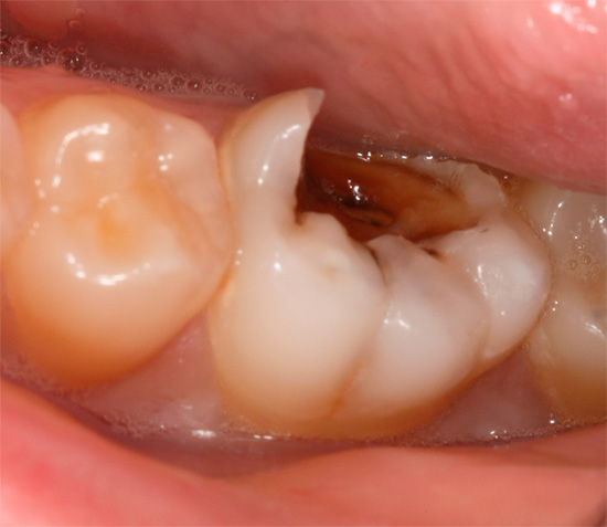 A characteristic feature of chronic pulpitis is mild symptomatology, which often leads to too late treatment for dental care ...