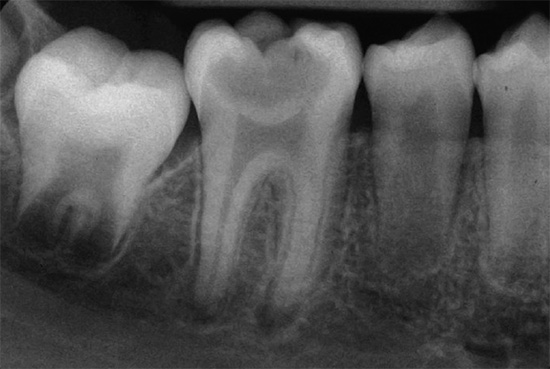 تكشف الصور الشعاعية عن الأمراض الخفية في الأسنان والأنسجة المحيطة بها ، بالإضافة إلى تقييم طول وشكل قنوات الجذر.