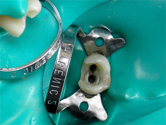 During the treatment of pulpitis, when cleaning the root canals, the doctor may make mistakes, which sometimes lead to very serious consequences ...