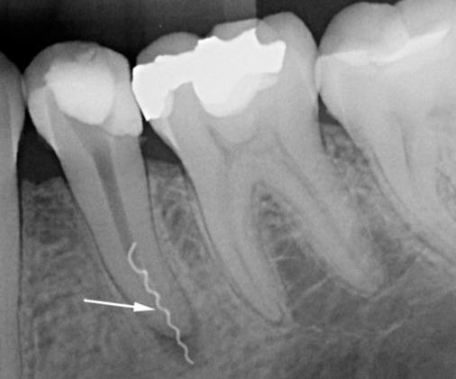 Röntgenkuvauksessa instrumentin murtunut kärki hampaan juuressa on selvästi näkyvissä.