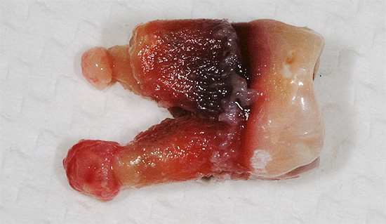De vorming van cysten op de wortels van de tand leidt vaak tot de noodzaak om deze te verwijderen.