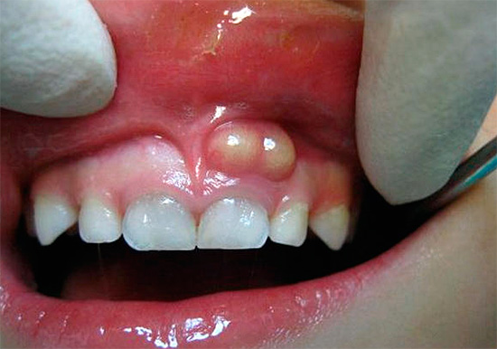 The photo shows the flux on the gum of a child