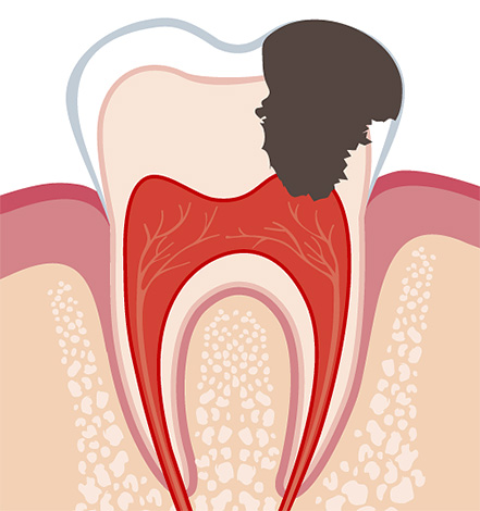 Pulpitas išsivysto, kai infekcija patenka į danties nervą, sukeldamas jo uždegimą.