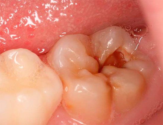 The most common cause of pulpitis, including chronic, is deep caries.