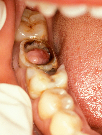 The photo shows another example of hypertrophic pulpitis.
