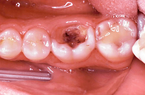 If the carious cavity has direct communication with the pulp chamber, then pus has an outlet, and acute pain may not be observed.