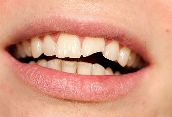 Avec des dommages mécaniques aux dents, une pulpite traumatique peut se développer.