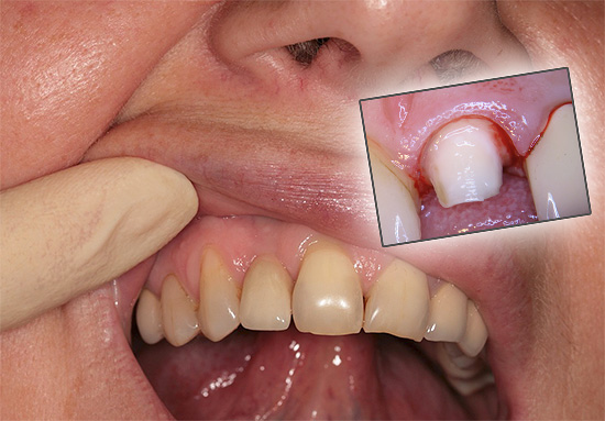 دعونا نرى لماذا يؤلم الأسنان أحيانًا تحت التاج وما الذي يمكن فعله في مثل هذه الحالات لتخفيف المعاناة ...