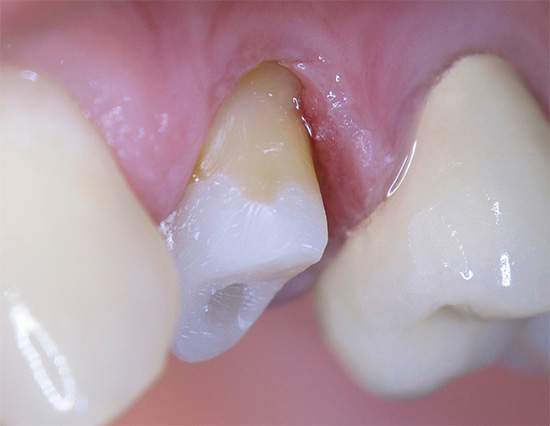 Chaque couronne est caractérisée par une durée de vie spécifique, après quoi la dent en dessous peut bien tomber malade.