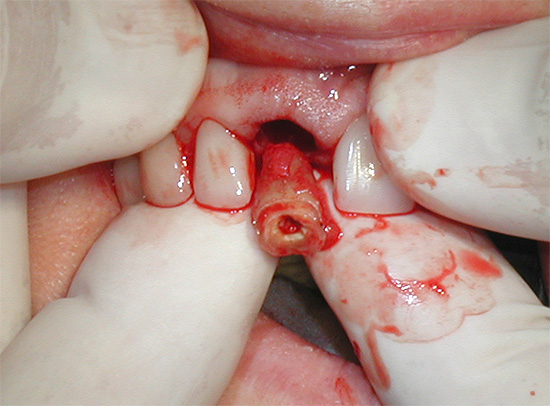 บางครั้งแพทย์ตัดสินใจที่จะถอดฟันหากการป้องกันด้วยมงกุฎของเขาเป็นไปไม่ได้และเหมาะสม