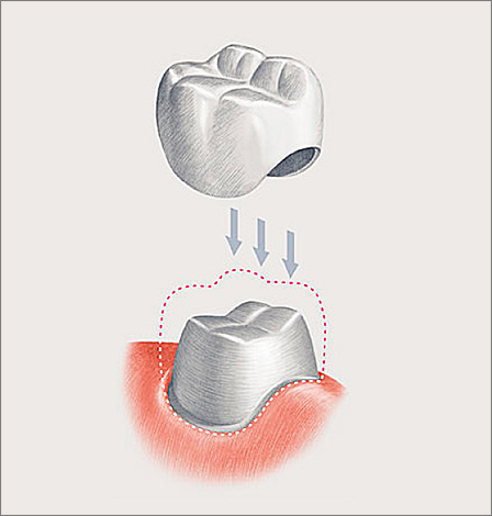 Nuotraukoje schematiškai parodytas klasikinis dantų vainikėlis.