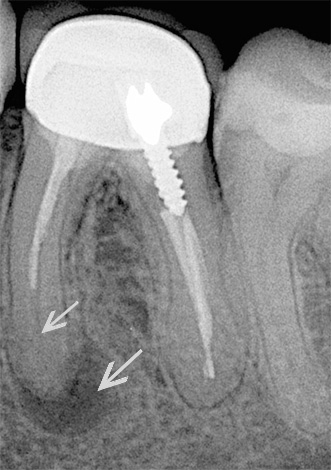 La imagen del diente muestra un canal no completamente lleno y un granuloma en la raíz.