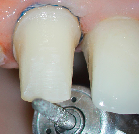 During the turning of the tooth under the crown, it can become very hot, which can lead to pulp necrosis.