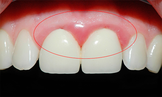 Sometimes an incorrectly installed crown can injure the gum, as a result of which its inflammation develops ...