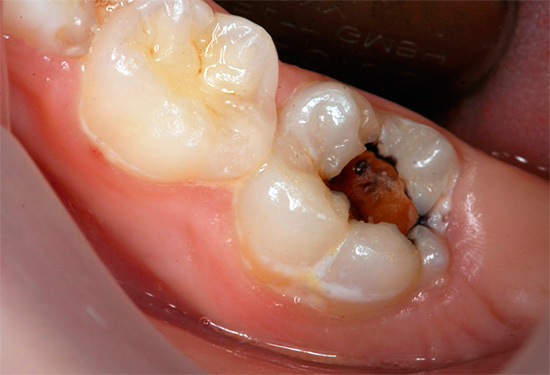 При много силен зъбобол в повечето случаи Analgin ще бъде неефективно лекарство.