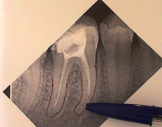Un'altra radiografia, che mostra che un canale dentale non è sigillato all'apice della radice.