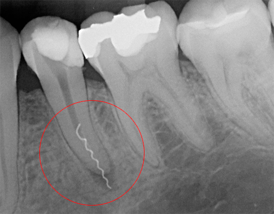 Der Bruch eines zahnärztlichen Instruments im Zahnkanal ist ein medizinischer Fehler, der, wenn er nicht korrigiert wird, zu weiteren Schmerzen und Entzündungen in der Wurzel führen kann.