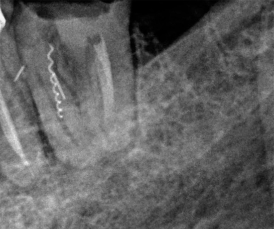Un altro colpo che mostra un pezzo di uno strumento dentale bloccato in un canale.