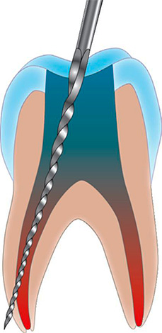 Čest uzrok boli nakon punjenja zuba u kojem je uklonjen živac je perforacija stijenke korijenskog kanala.