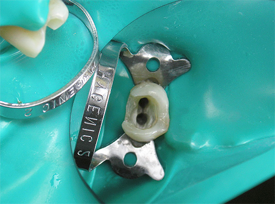 Užpildanti medžiaga, kuria užpildyti šaknies kanalai po valymo gali sukelti alerginę reakciją minkštuosiuose audiniuose, esančiuose aplink dantį.