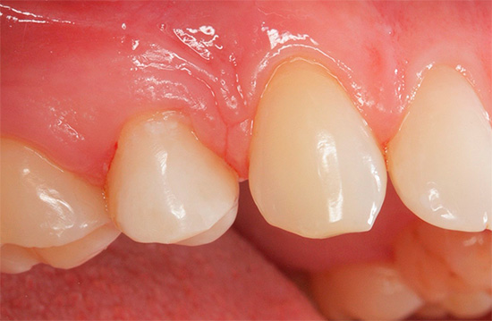 A causa di un'allergia al materiale di riempimento, le gengive accanto a un dente morto possono essere costantemente infiammate e ferite.